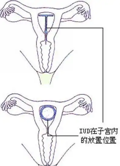 图片揭秘女人带环全过程做个女人真不容易