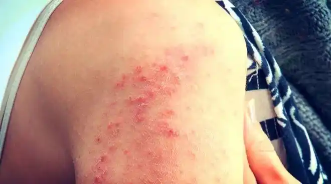 荨麻疹|湿疹|瘙痒|皮炎|炎症_网易订阅