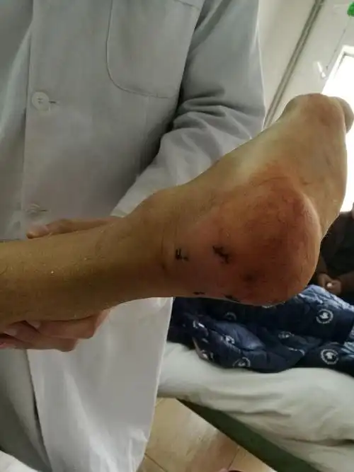 病例二患者男性55岁,右跟骨粉碎性骨折