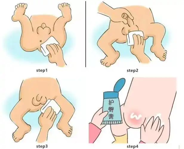男宝宝屁屁清洗图示及步骤①用温水把干棉柔纸巾沾湿,轻轻擦干净肛门