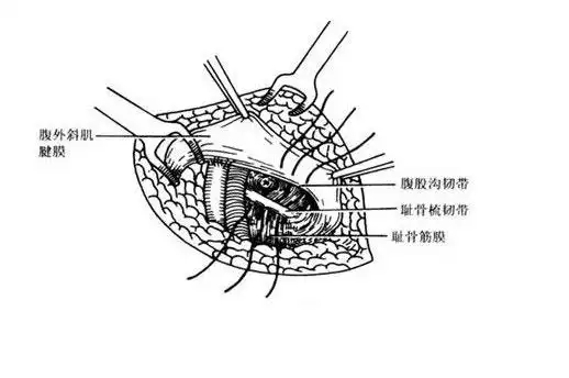 腹股沟下入径 将腹股韧带与耻骨梳韧带及耻骨筋膜缝合.