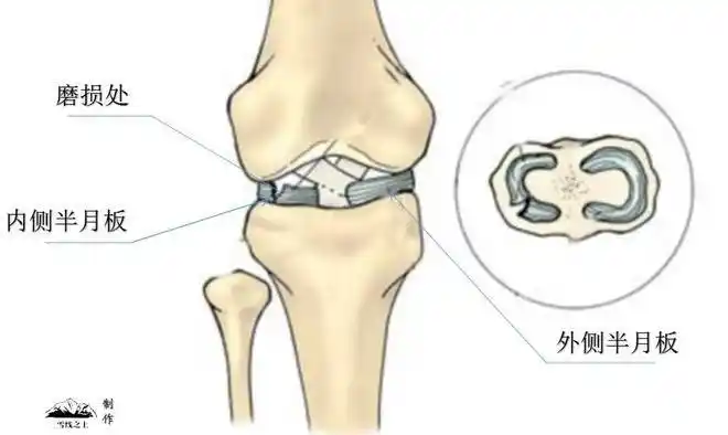 直到膝盖中了一箭|关节|肌肉|半月板|半月板损伤|髌骨_网易订阅