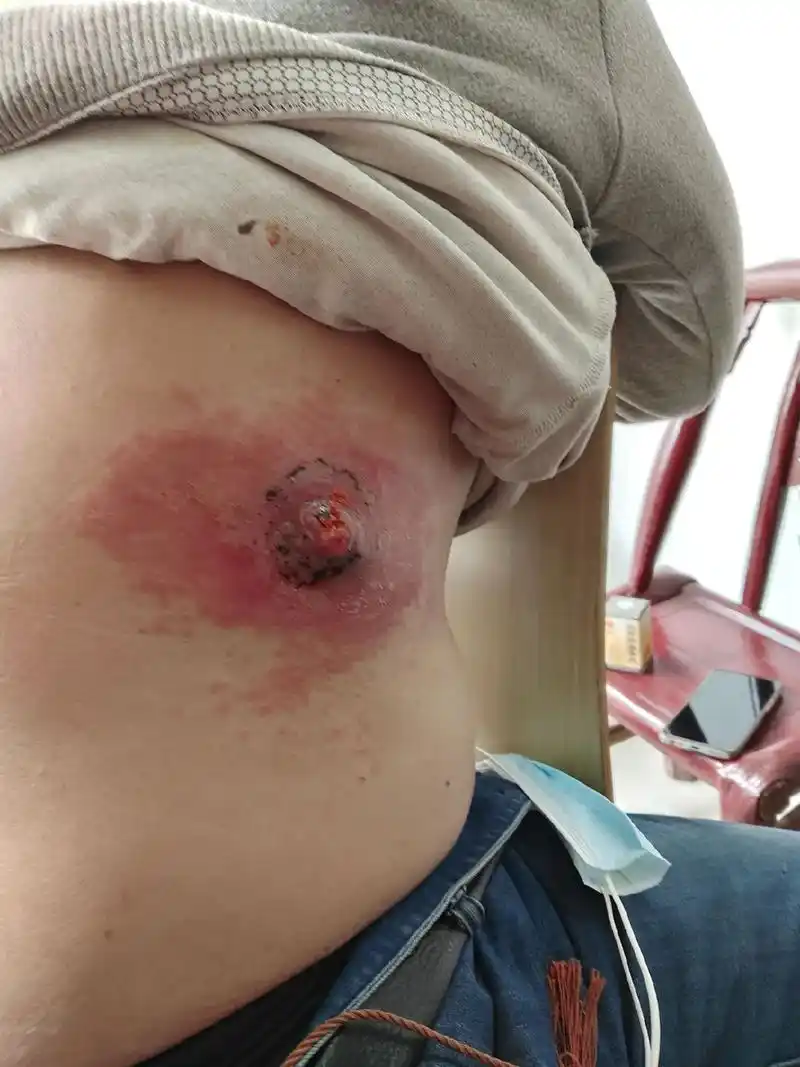 蜂窝组织炎,前面两张在别的地方看了很长时间没看好,后面两张在 - 抖