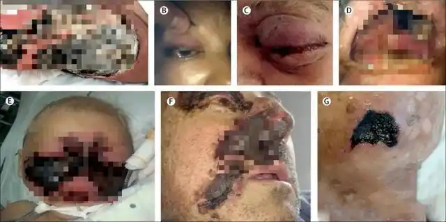 02感染毛霉菌病的原因毛霉菌在空气,土壤,粪便,腐烂的食物等环境中