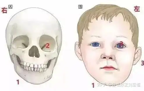 恒牙咬合异常,影响孩子的面部发育,让原本可爱的孩子发生颌面部畸形