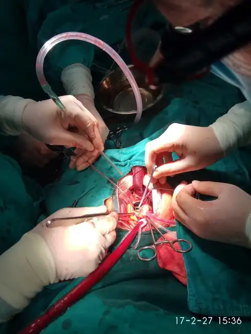 成人胸骨下段切口体外循环下心脏直视手术!心脏疾病胸骨下段切口