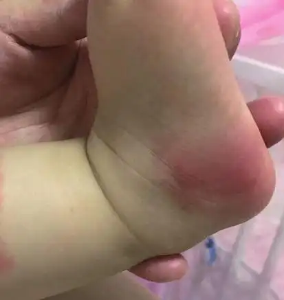 新生儿被蚊子咬怎么办 新生儿被蚊子咬怎么办图片