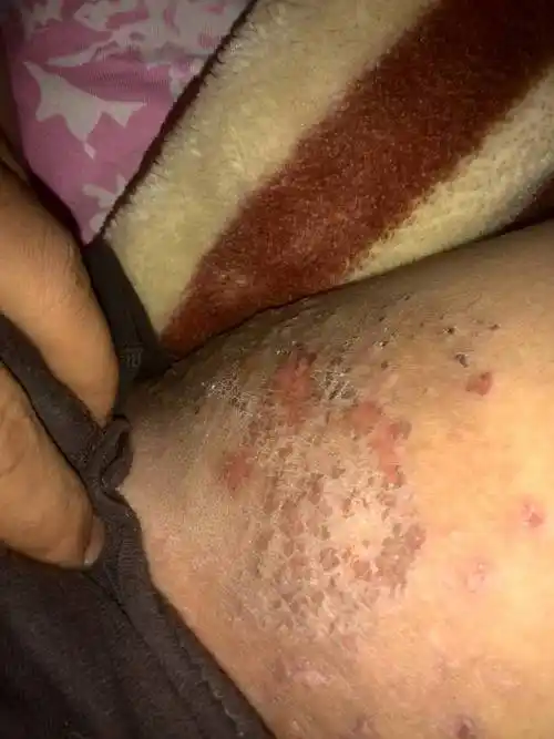 我这个大腿内侧长了一些瘙痒的东西.长了两个多月了.只要一热就痒.