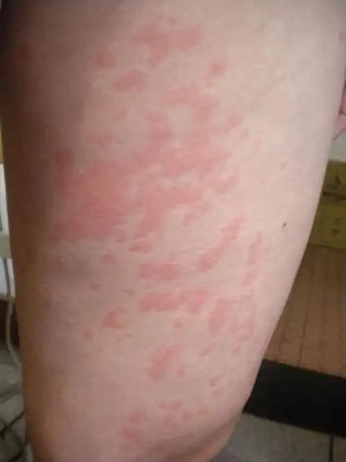 全身都是红疙瘩,特别痒,看了医生,医生开的药也吃了,吊针也打了,吃完