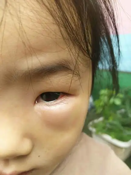 三岁宝宝,眼睛反复肿,昨天晚上肿了一次,像水泡一样