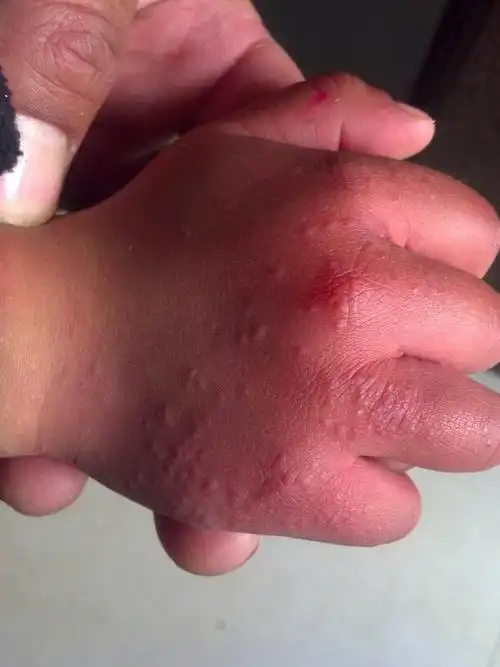 孩子的手起的小疙瘩是什么皮肤病怎么治疗