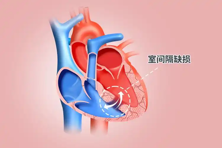 室间隔缺损图