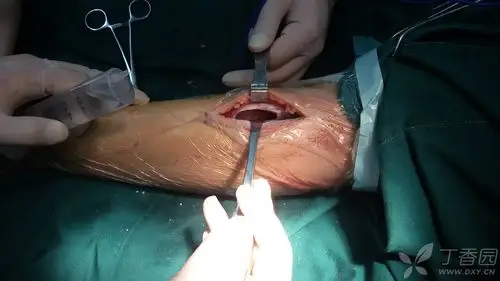 一例10岁患者胫骨中上段骨肿瘤(已更新术中图片,继续更新病理结果)!