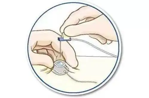 输液港知多d不再反复扎针静脉输液港减轻患者化疗痛苦
