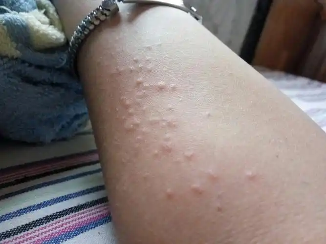 胳膊上起了好多小疙瘩,第一天不多感觉没啥事儿,第二天痒挠了一下就多