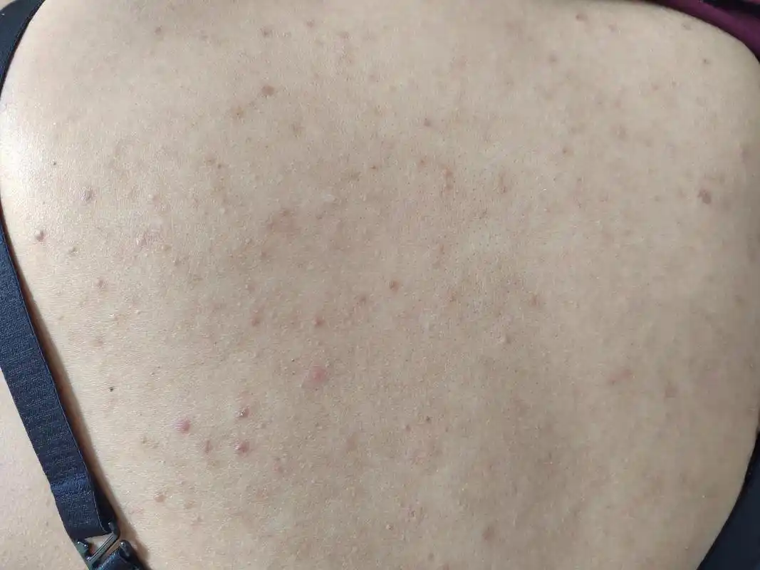 前胸后背的毛囊炎症状.考虑马拉色菌感染引起的传染性皮肤病.马拉色菌