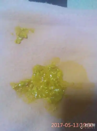 有图慎入,月子里的宝宝拉水样大便