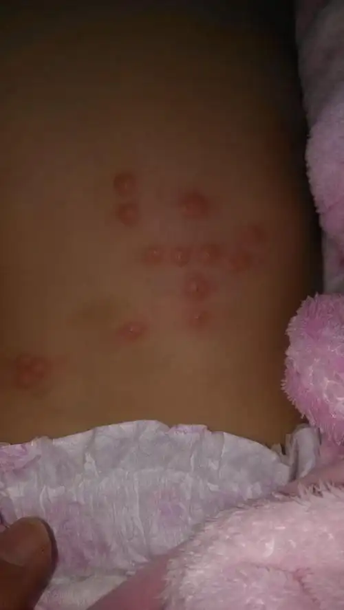 求求大夫们告诉我宝宝身上起的红疹是什么啊?