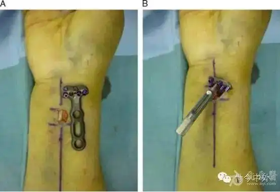 1厘米切口做桡骨远端钢板内固定!
