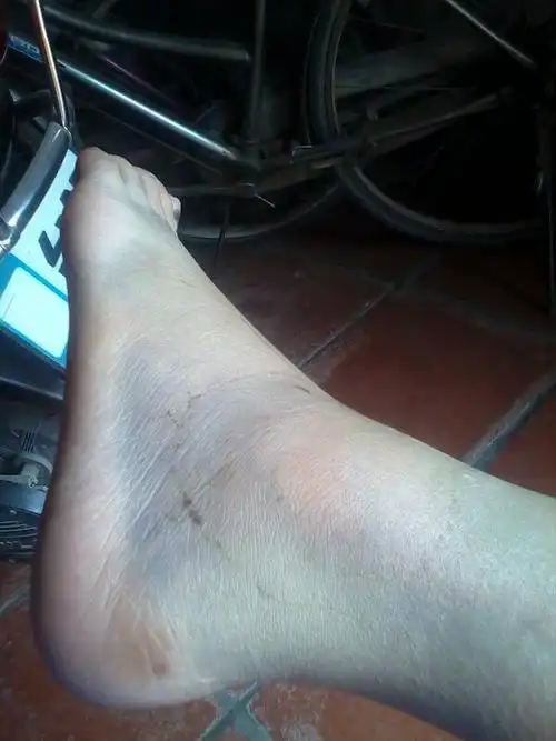 脚踝扭到,血肿严重,现在都20天走路还