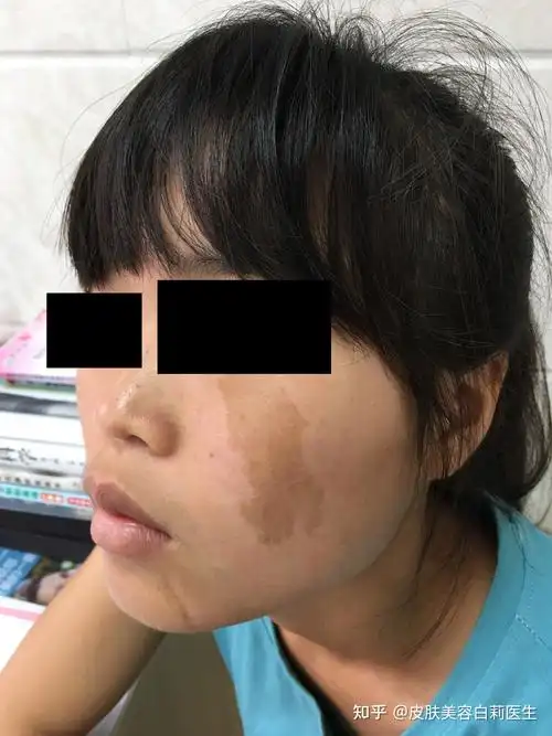 案例3你的脸上也有这种咖啡斑吗早点做激光治疗会比较好哦