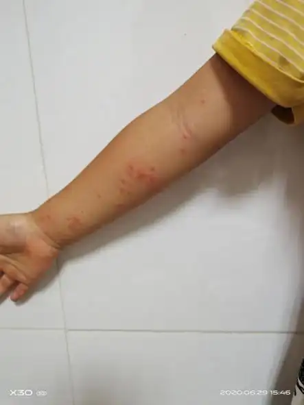 【提醒】身上落了毛毛虫,直接拍死后果严重!