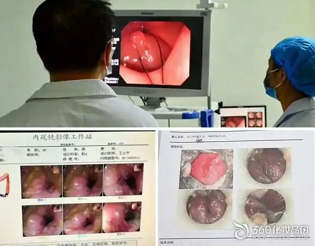 西安东大肛肠医院肛门处突然长了个包是怎么回事