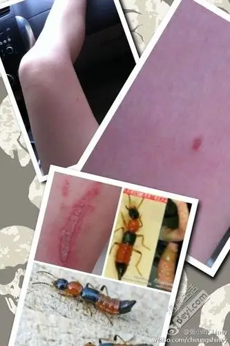 有图有真相~被"青腰虫"咬了一个好大的包.现在才发现,后知后觉啊!哭