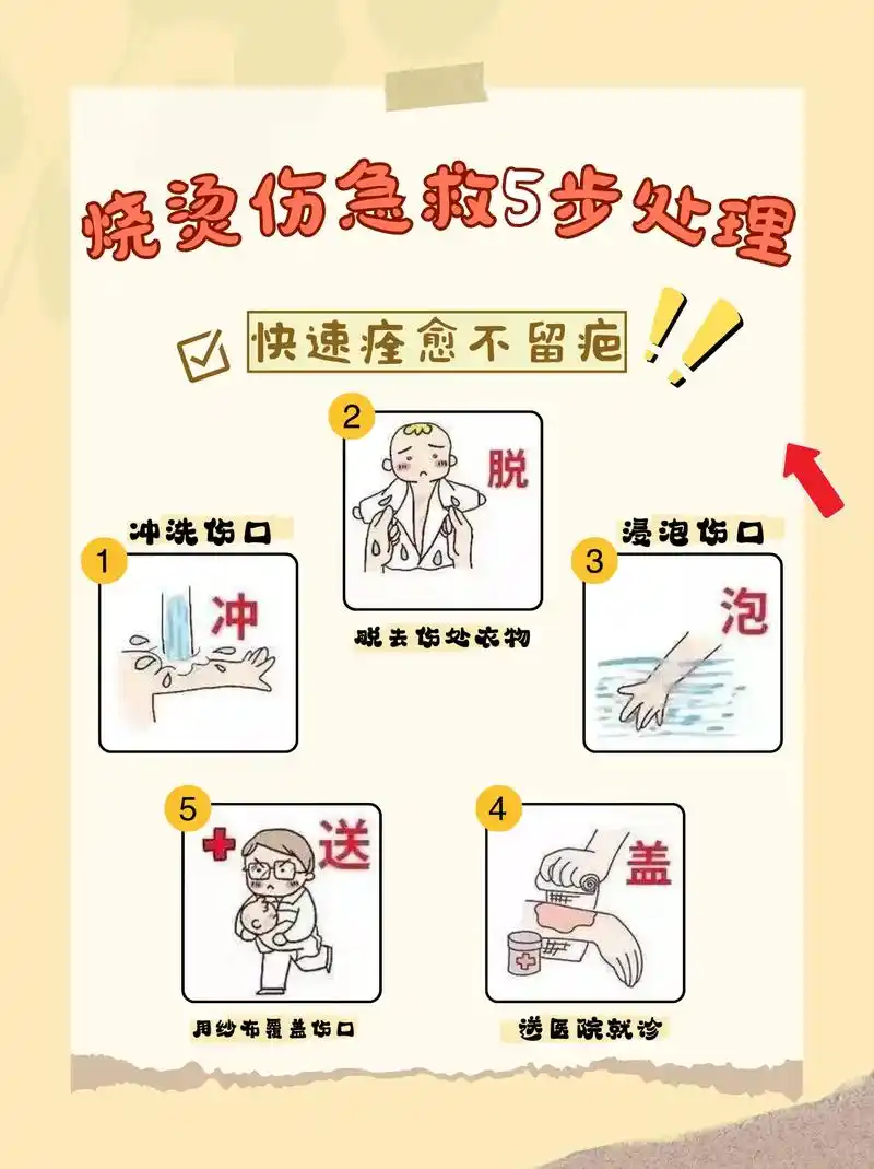 烧烫伤急救5步法.烫伤急救处理-冲,脱,跑,盖,送 快来记住 - 抖音