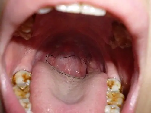 喉咙里起泡,还一个劲的咳嗽