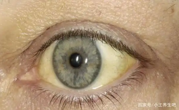 巩膜发黄 当我们的身体健康时巩膜会呈现出白颜色,那么如果巩膜发黄时