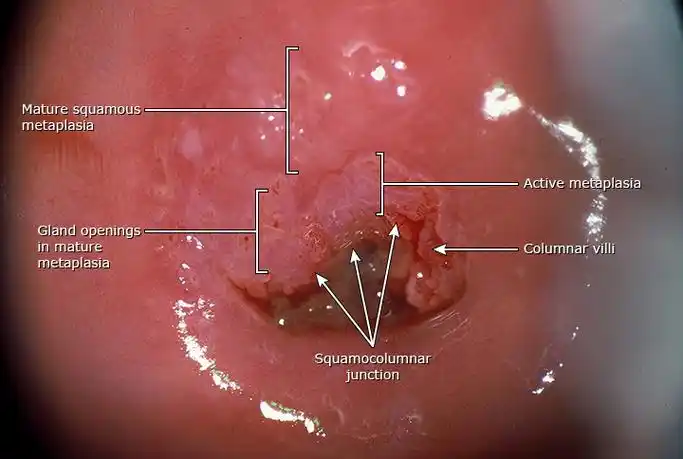 常见于青春期以后的青少年,妊娠女性和使用含有雌激素避孕用品的女
