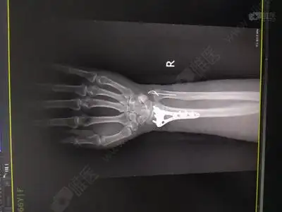 右尺桡骨远端骨折1例