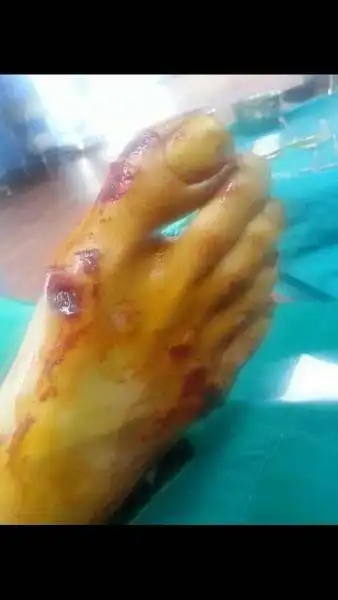 薛之谦国外拍片遇车祸 脚部被钢钉刺穿