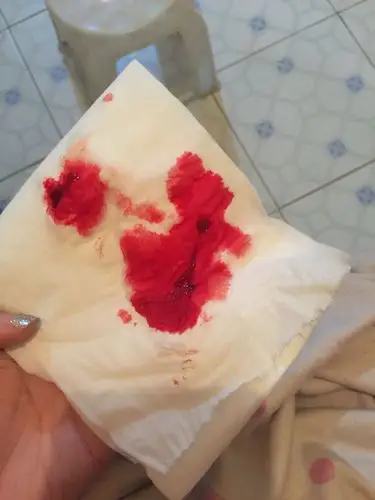 今天小腹微坠痛,腰胀痛,排便后一擦屁股发现纸上鲜红的血迹量多