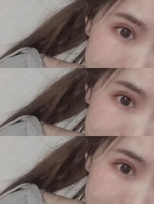 做双眼皮手术已经有20天了,眼睛恢复的越来越自然,怎么看都喜欢,现在