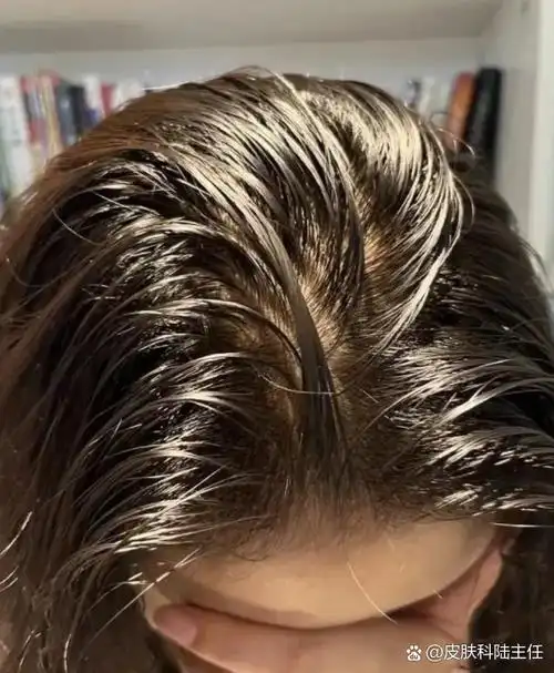 比如经常吃辛辣,高脂肪的食物,会让头皮出油变多,头发就容易显得油腻