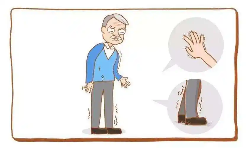 什么是帕金森综合症(什么是帕金森综合症运动障碍)