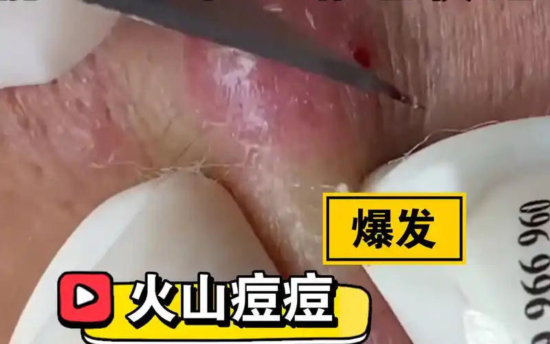 【解压助眠】针清|面部护理|深层清洁|黑头粉刺|毛孔粗大|果粒橙|沉浸