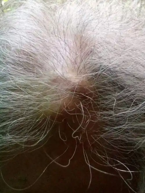 这是头顶上的脑骨瘤有五十余年,吃产品后意外的消除啦.