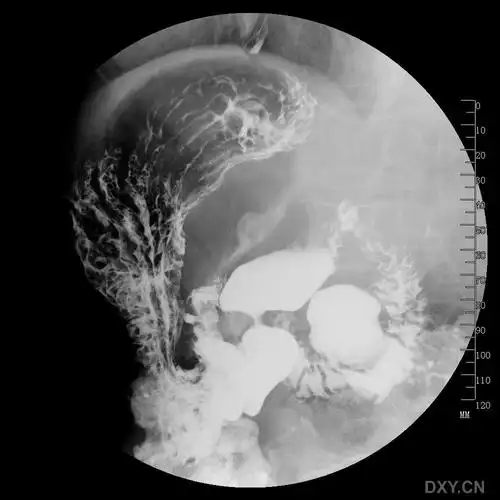 【读片】12指肠水平部大憩室一例! [病例帖]