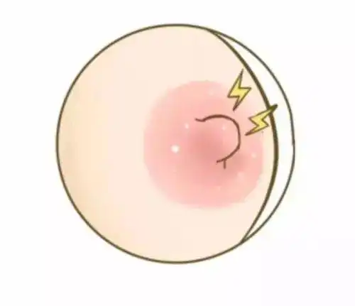 哺乳期妈妈乳头出现白点白泡怎么回事该怎么处理