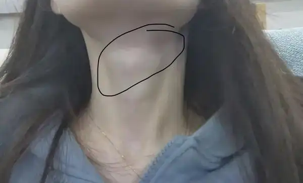 我的脖子仰起头会有凸起的东西,但好像只有少数人有,请问有人知道是啥