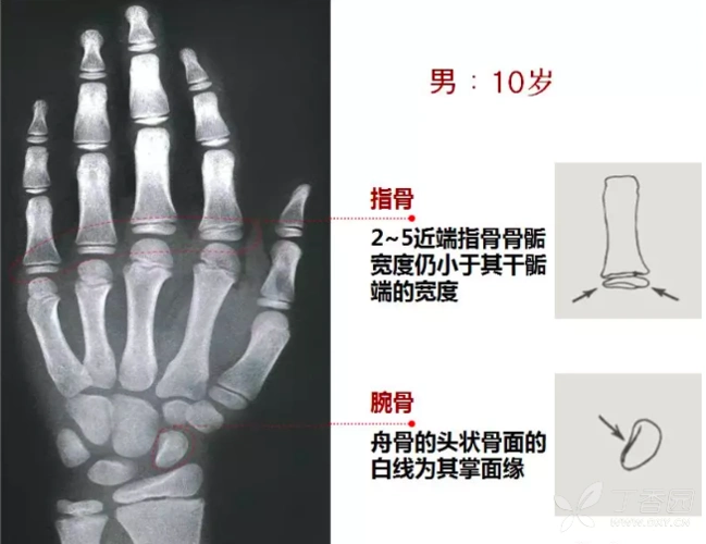 最全骨龄图谱:男孩女孩都有