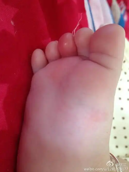 请问婴儿70多天脚趾头被不明物体咬了?