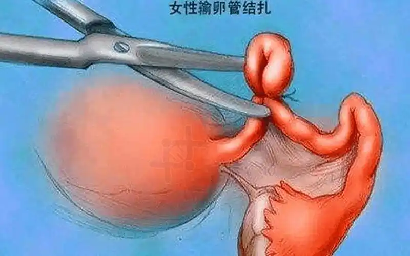 上环vs避孕药vs结扎3种节育方式伤害有不同