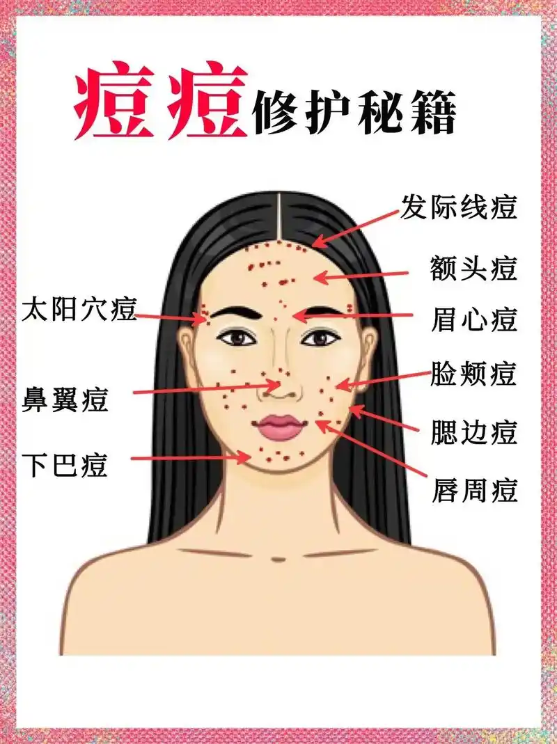 建议收藏97.痘痘分为多种类型,预防方面需 - 抖音