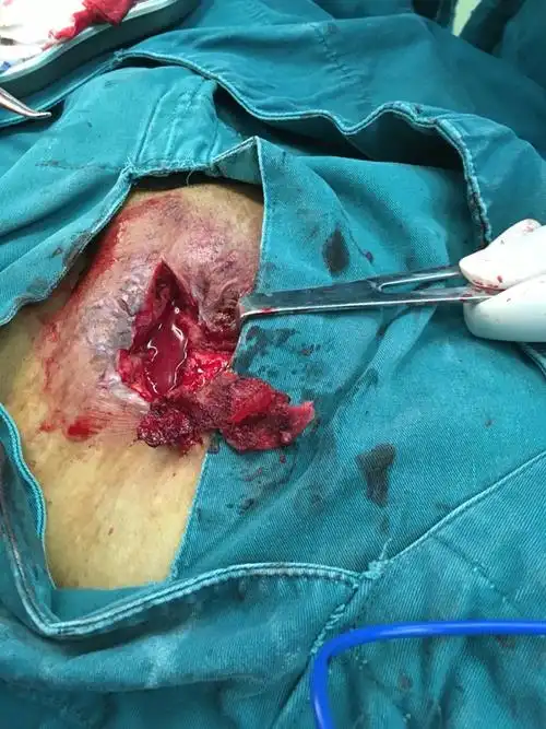 于细微处见真知--------左侧腹股沟疝术后补片感染取出术