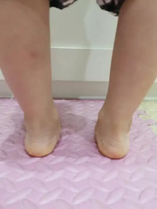 足外翻垫脚训练后三个月