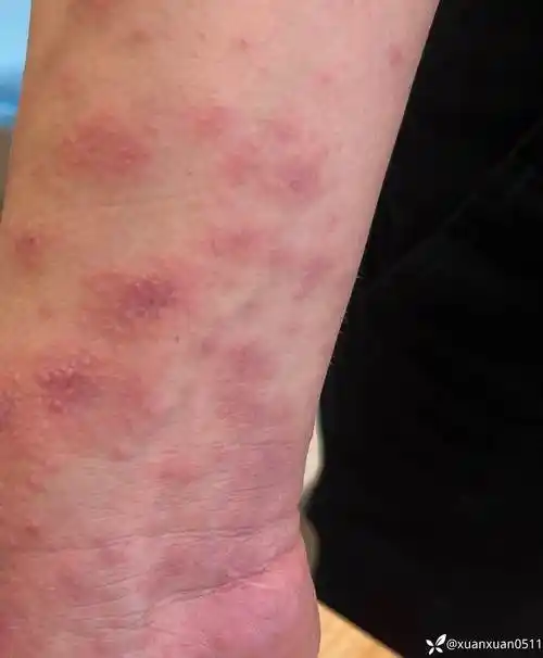 湿疹多行性红斑